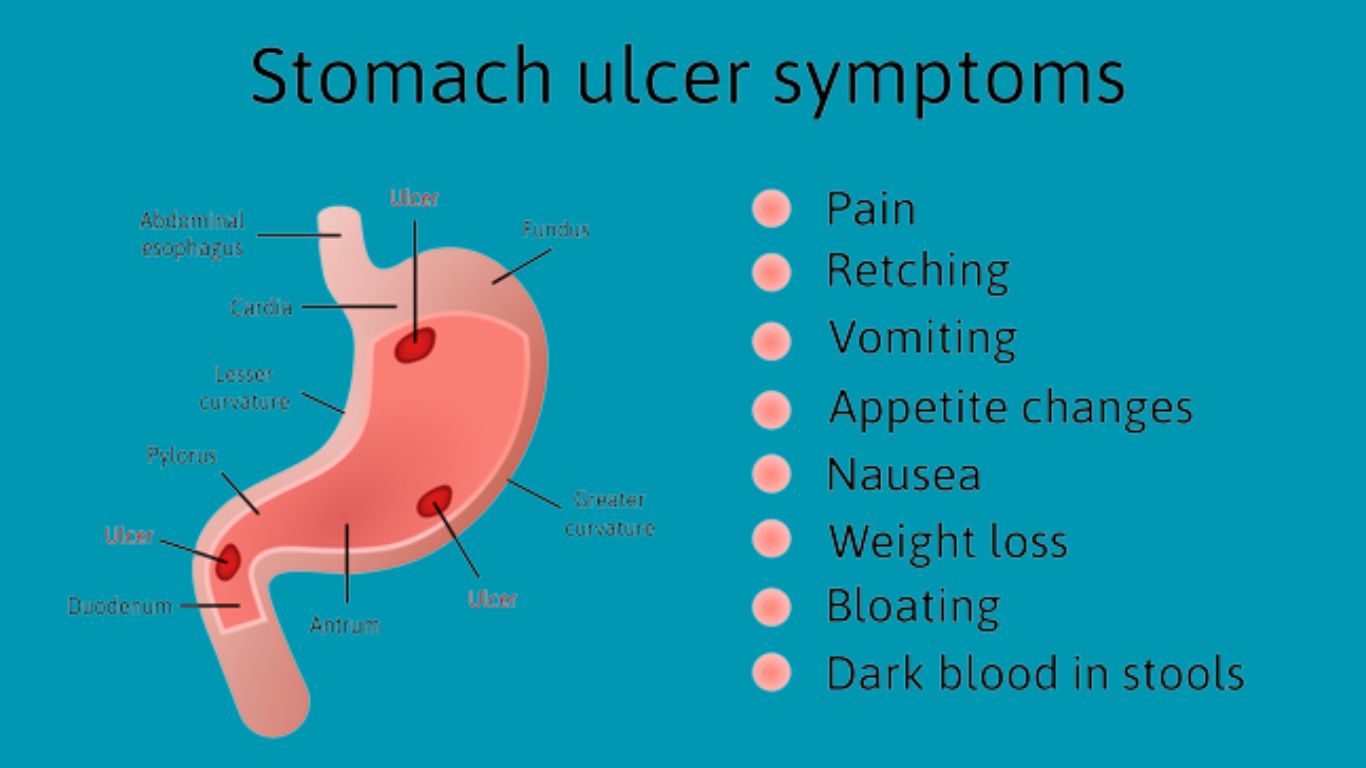 what Peritonitis means? - Causes, Symptoms, Test, and Treatment